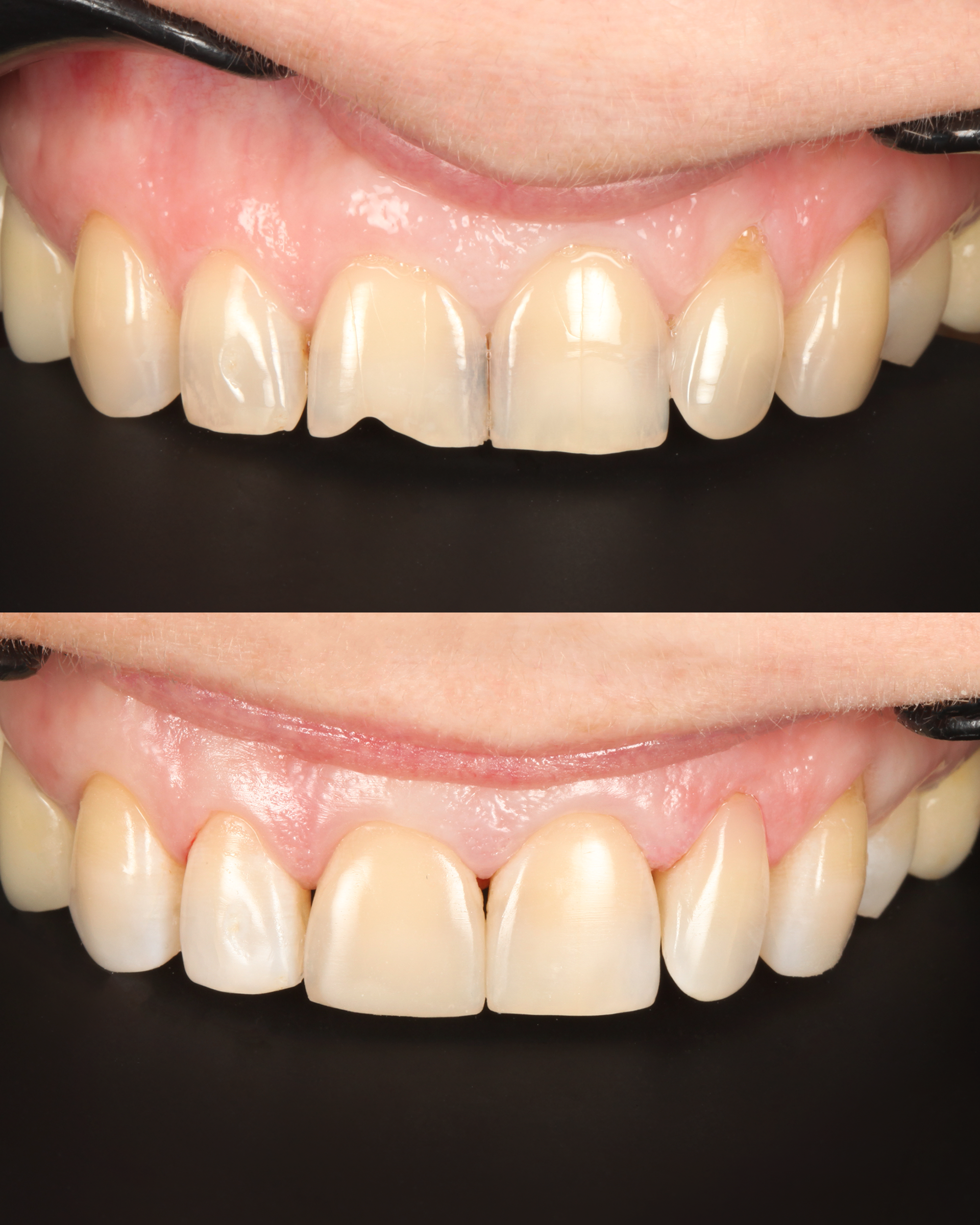 Художественная реставрация — до и после